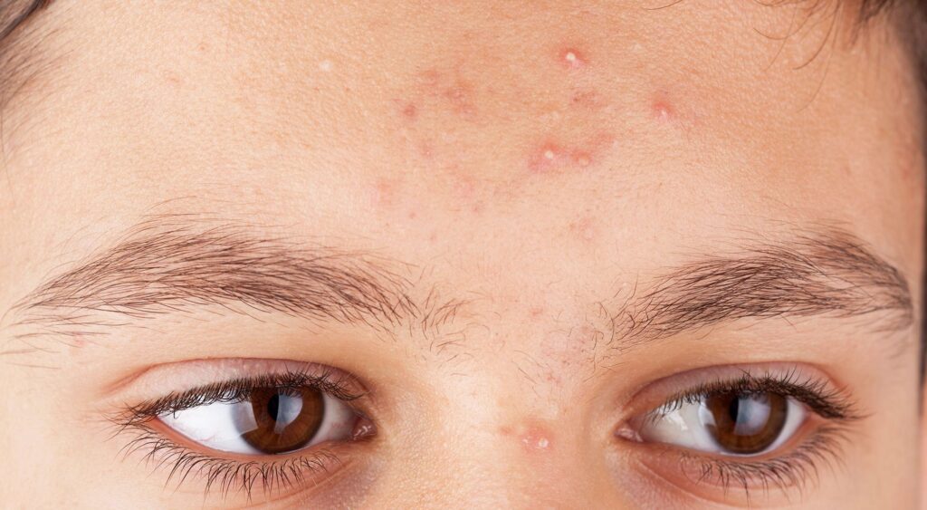 Remove Whiteheads At Home